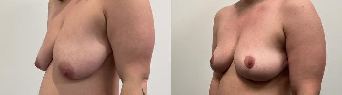 Before & After Breast Lift Case 499 Left Oblique View in Albany, Latham & Saratoga, New York