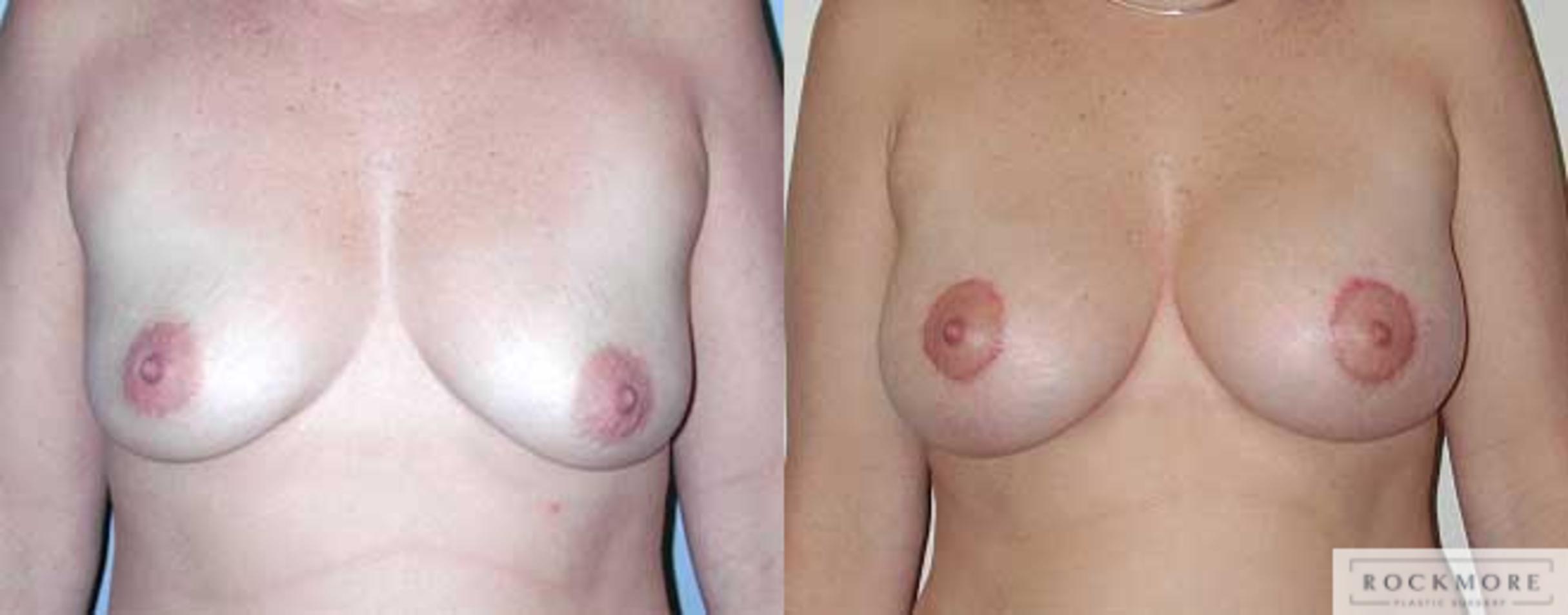 Before & After Breast Lift Case 5 View #1 View in Albany & Latham, New York