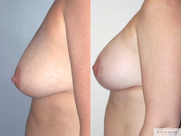 Before & After Breast Lift Case 5 View #2 View in Albany & Latham, New York