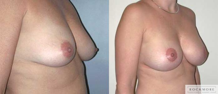 Before & After Breast Lift Case 5 View #3 View in Albany & Latham, New York