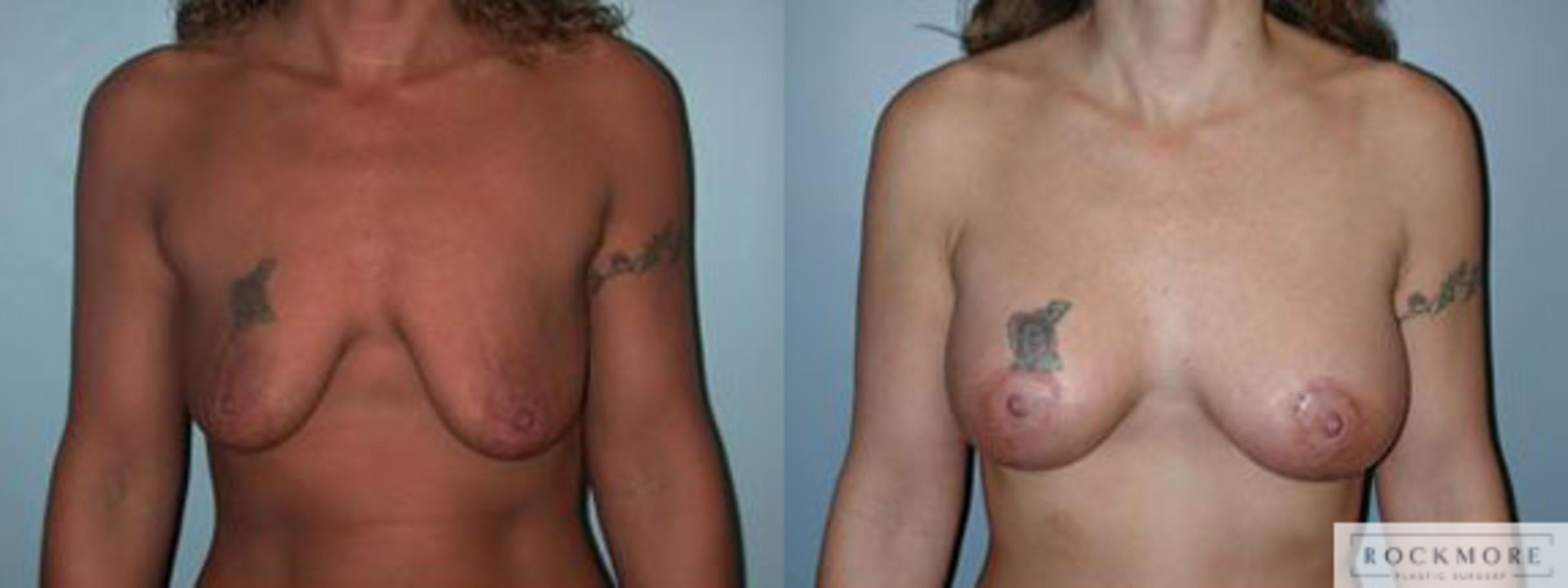 Before & After Breast Lift Case 64 View #1 View in Albany & Latham, New York