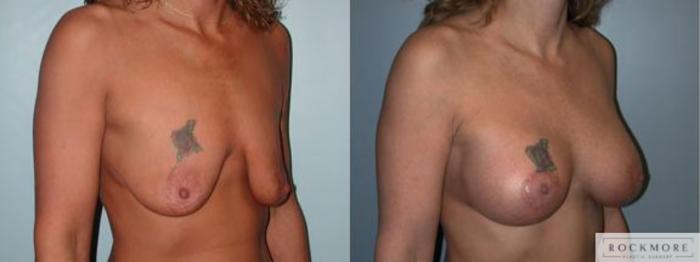 Before & After Breast Lift Case 64 View #2 View in Albany & Latham, New York