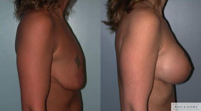 Before & After Breast Lift Case 64 View #3 View in Albany & Latham, New York