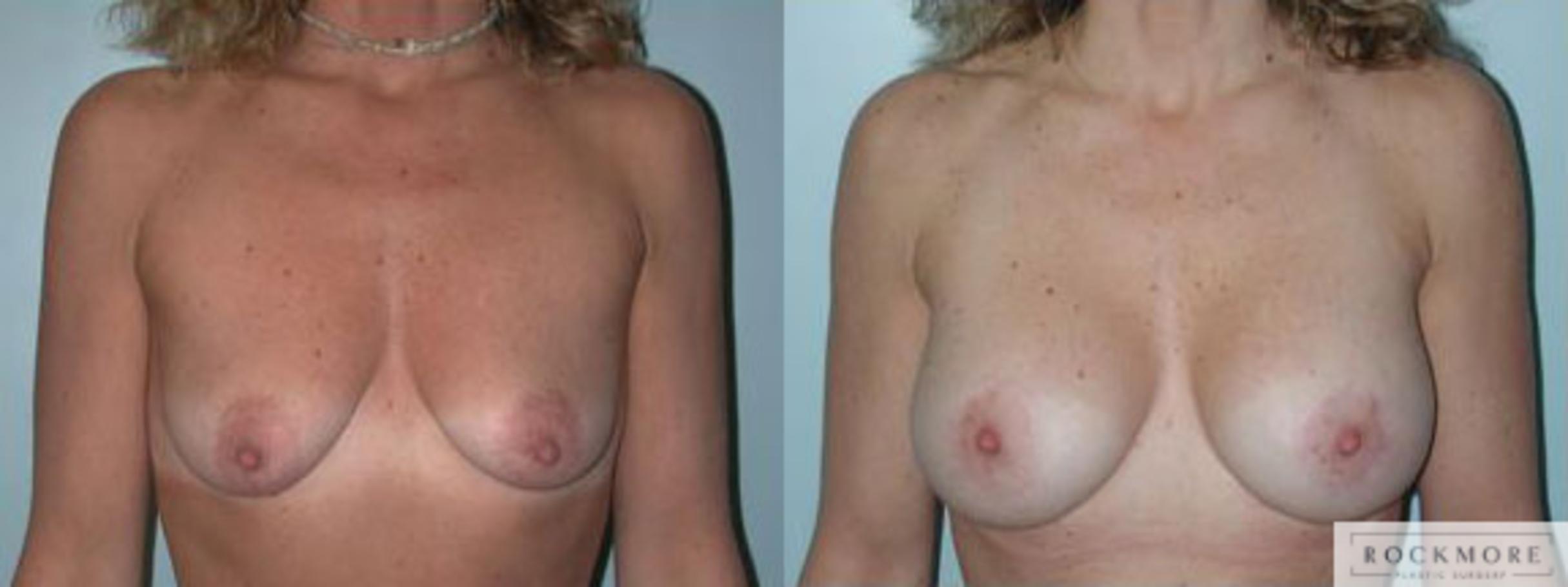 Before & After Breast Lift Case 94 View #1 View in Albany & Latham, New York