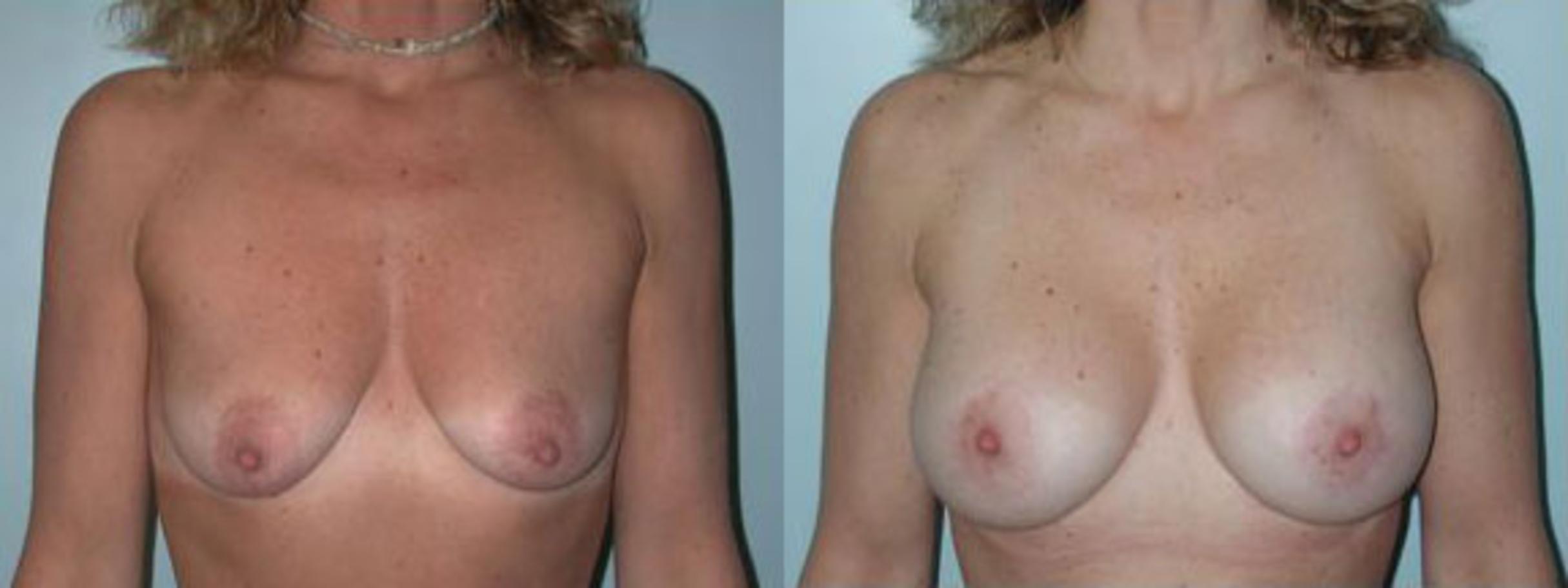 Before & After Breast Lift Case 94 View #1 View in Albany & Latham, New York