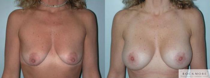 Before & After Breast Lift Case 94 View #1 View in Albany & Latham, New York