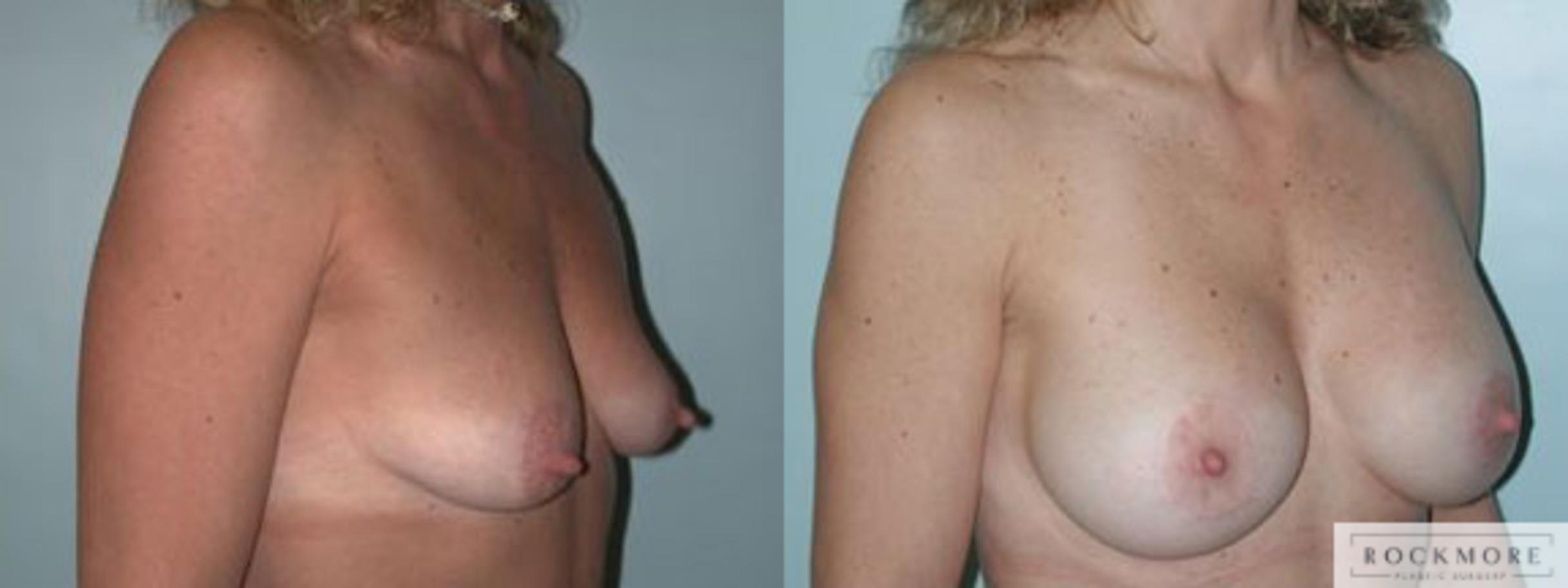 Before & After Breast Lift Case 94 View #2 View in Albany & Latham, New York