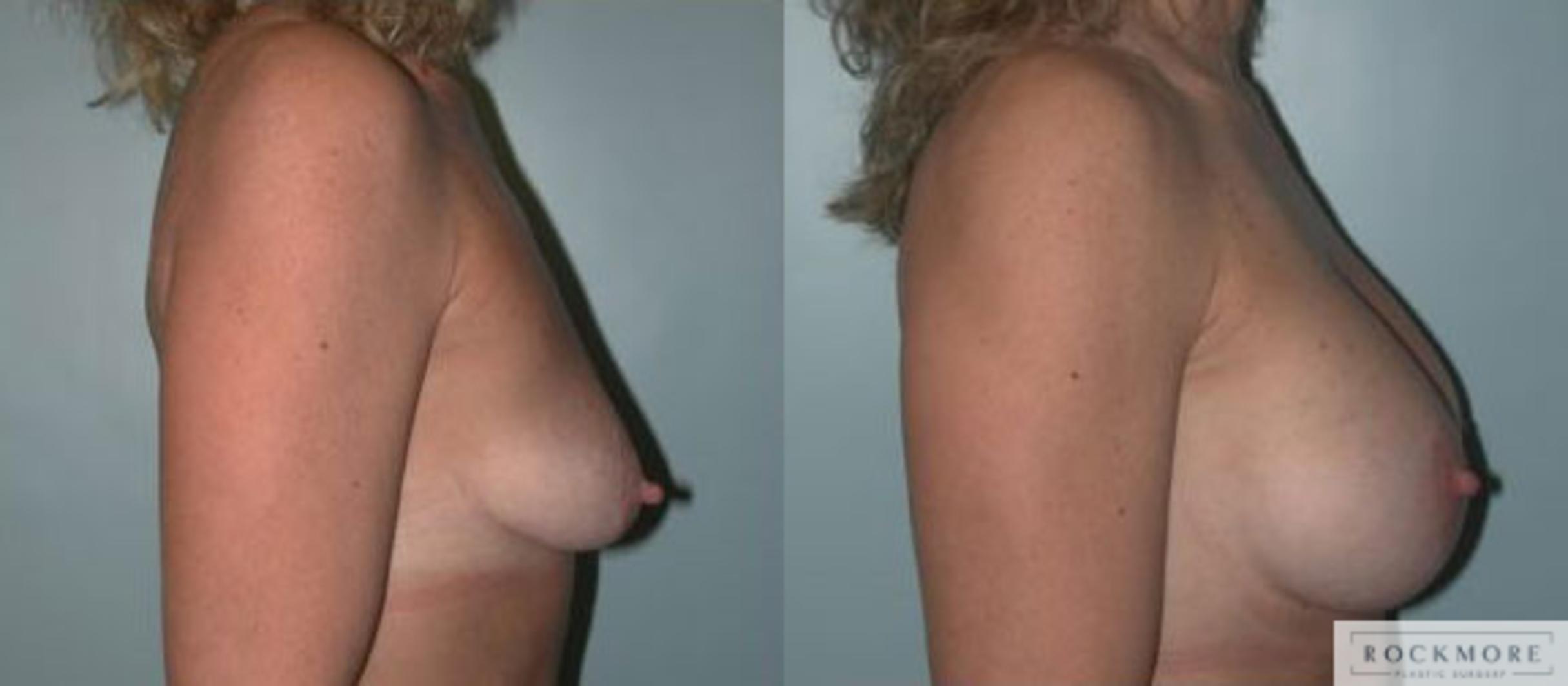 Before & After Breast Lift Case 94 View #3 View in Albany & Latham, New York