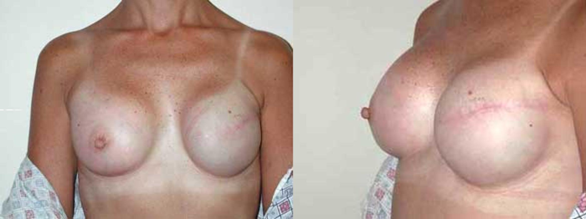 Before & After Breast Reconstruction Case 10 View #1 View in Albany & Latham, New York