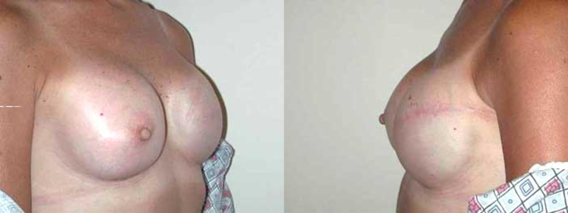 Before & After Breast Reconstruction Case 10 View #2 View in Albany & Latham, New York