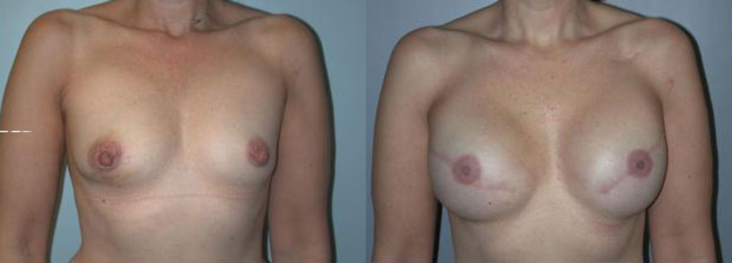 Before & After Breast Reconstruction Case 101 View #1 View in Albany & Latham, New York