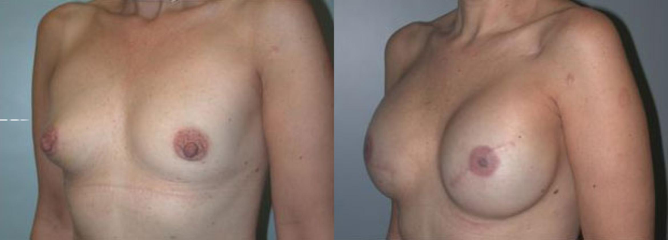 Before & After Breast Reconstruction Case 101 View #2 View in Albany & Latham, New York