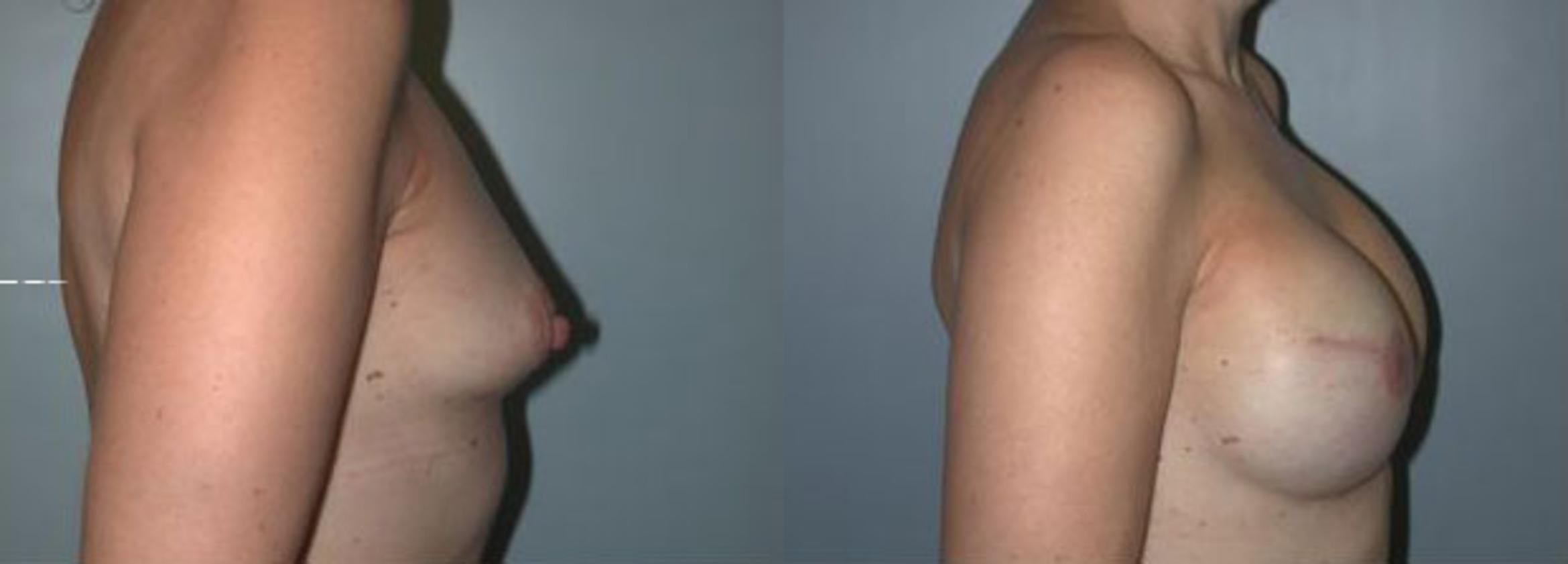 Before & After Breast Reconstruction Case 101 View #3 View in Albany & Latham, New York