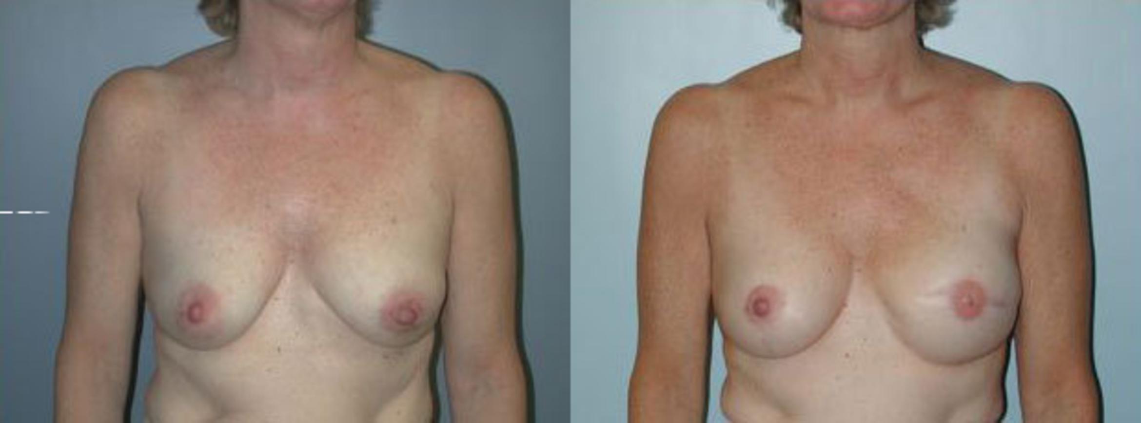 Before & After Breast Reconstruction Case 105 View #1 View in Albany & Latham, New York