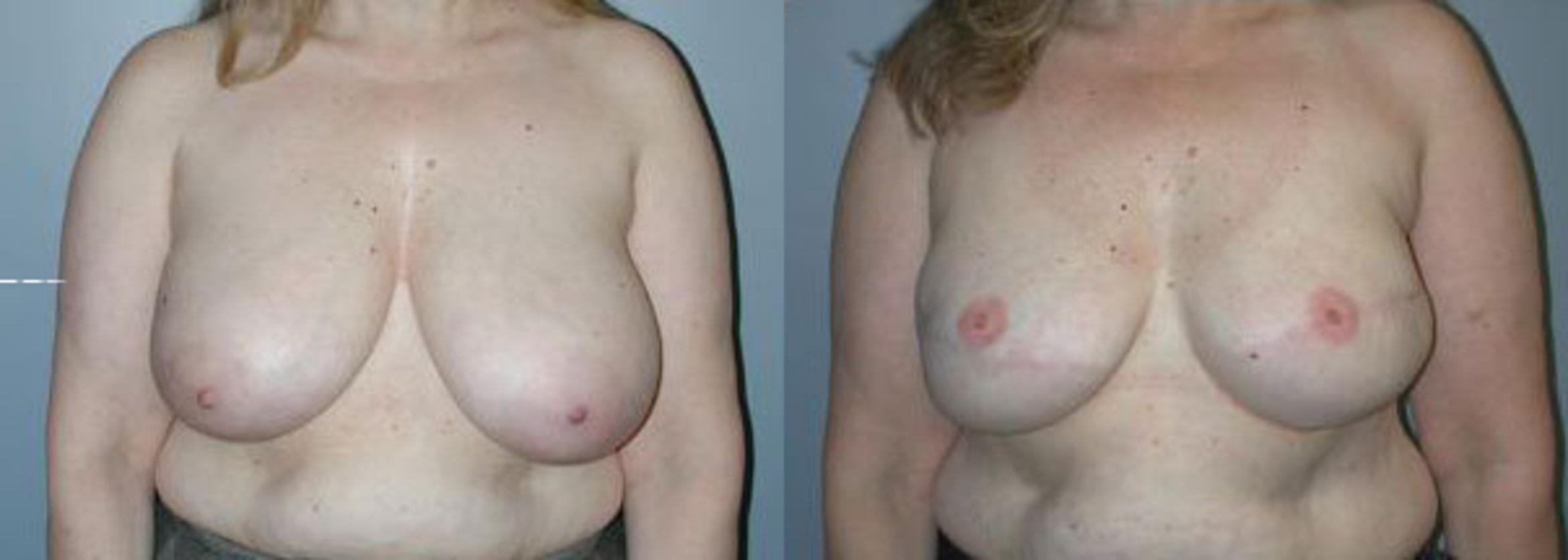 Before & After Breast Reconstruction Case 106 View #1 View in Albany & Latham, New York