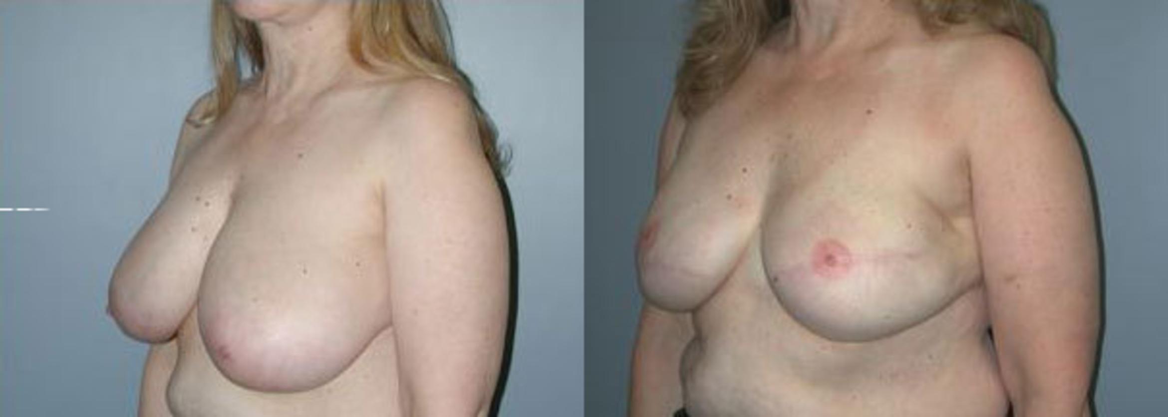 Before & After Breast Reconstruction Case 106 View #2 View in Albany & Latham, New York