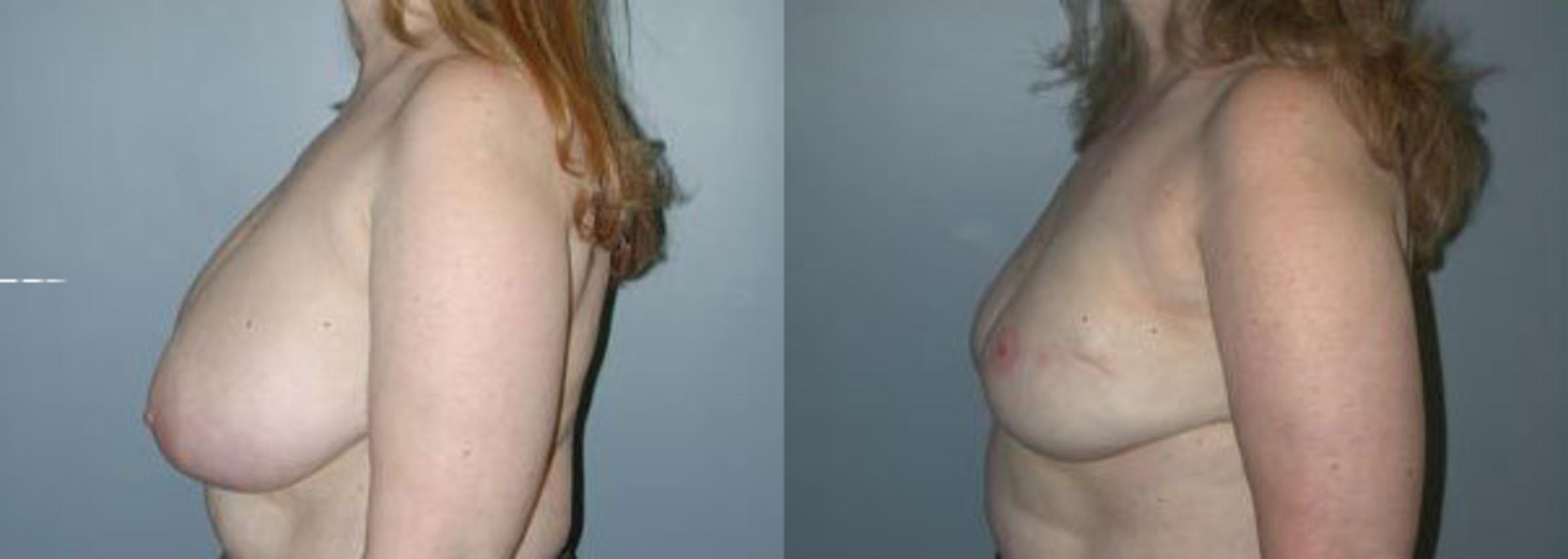 Before & After Breast Reconstruction Case 106 View #3 View in Albany & Latham, New York