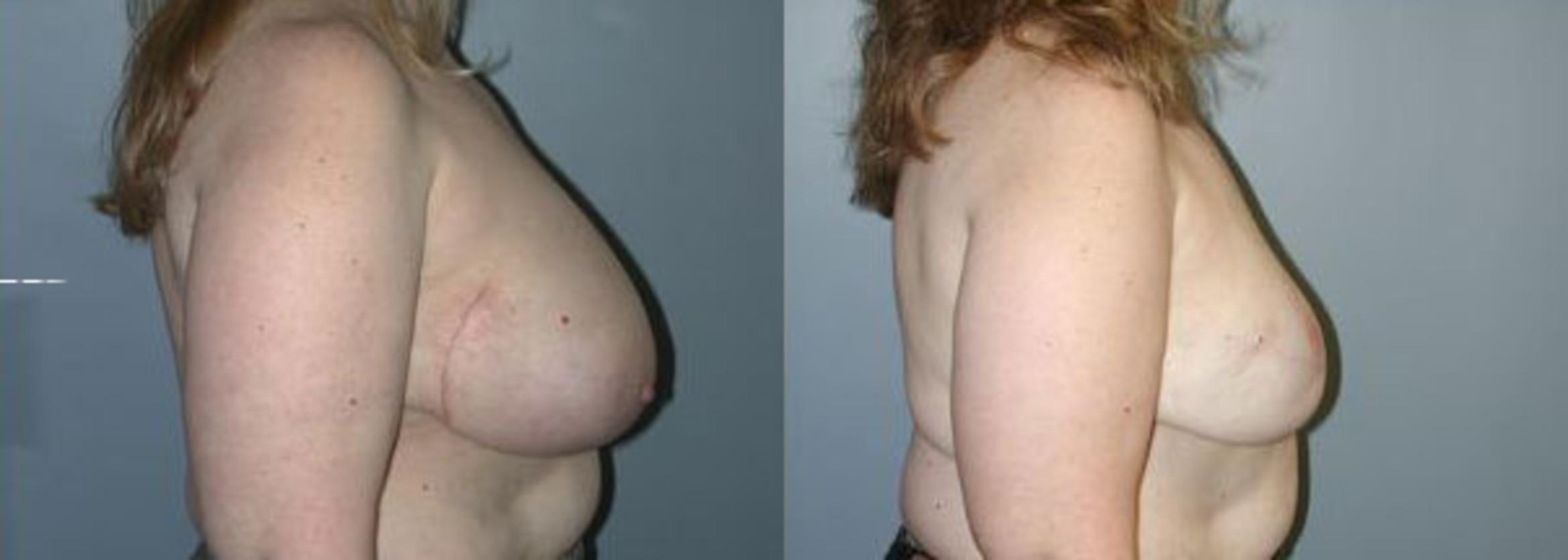 Before & After Breast Reconstruction Case 106 View #4 View in Albany & Latham, New York