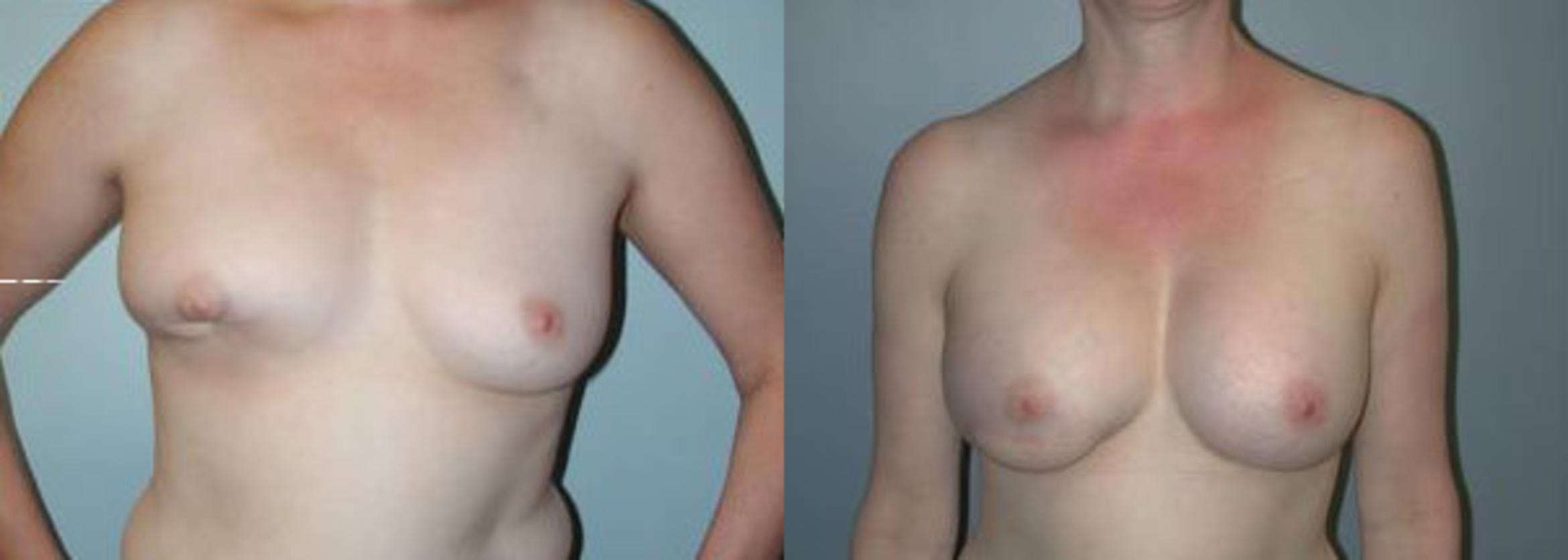 Before & After Breast Reconstruction Case 107 View #1 View in Albany & Latham, New York