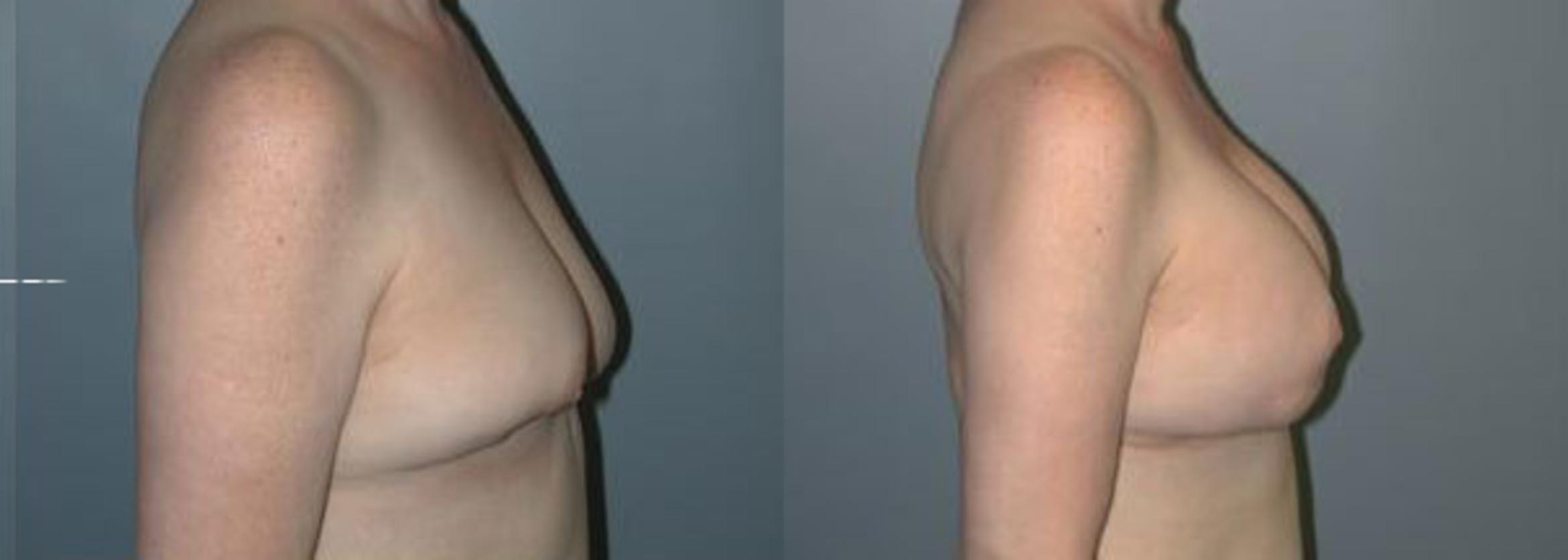 Before & After Breast Reconstruction Case 107 View #2 View in Albany & Latham, New York