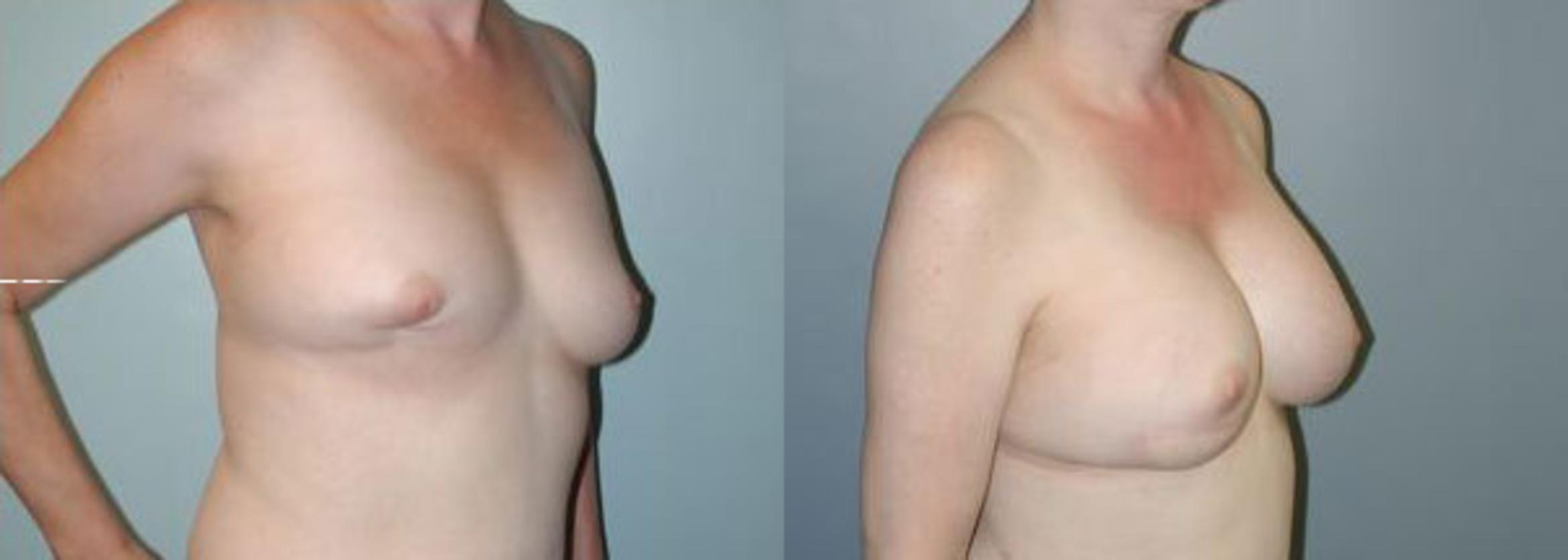 Before & After Breast Reconstruction Case 107 View #3 View in Albany & Latham, New York