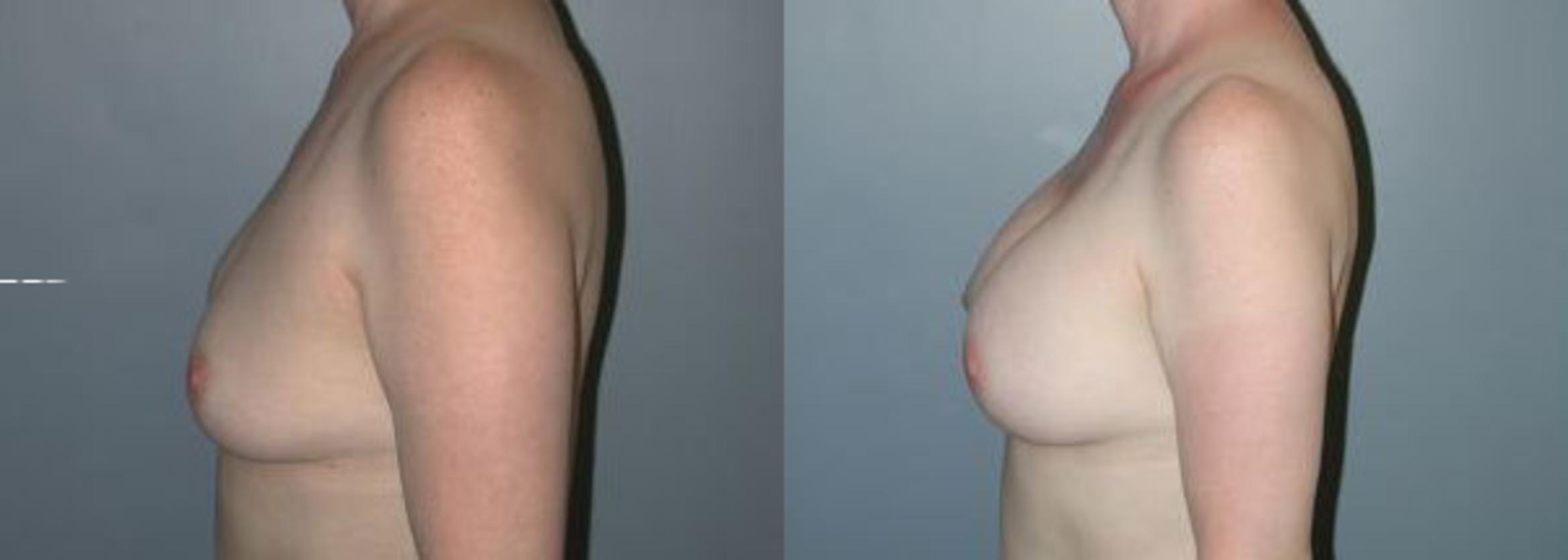Before & After Breast Reconstruction Case 107 View #4 View in Albany & Latham, New York