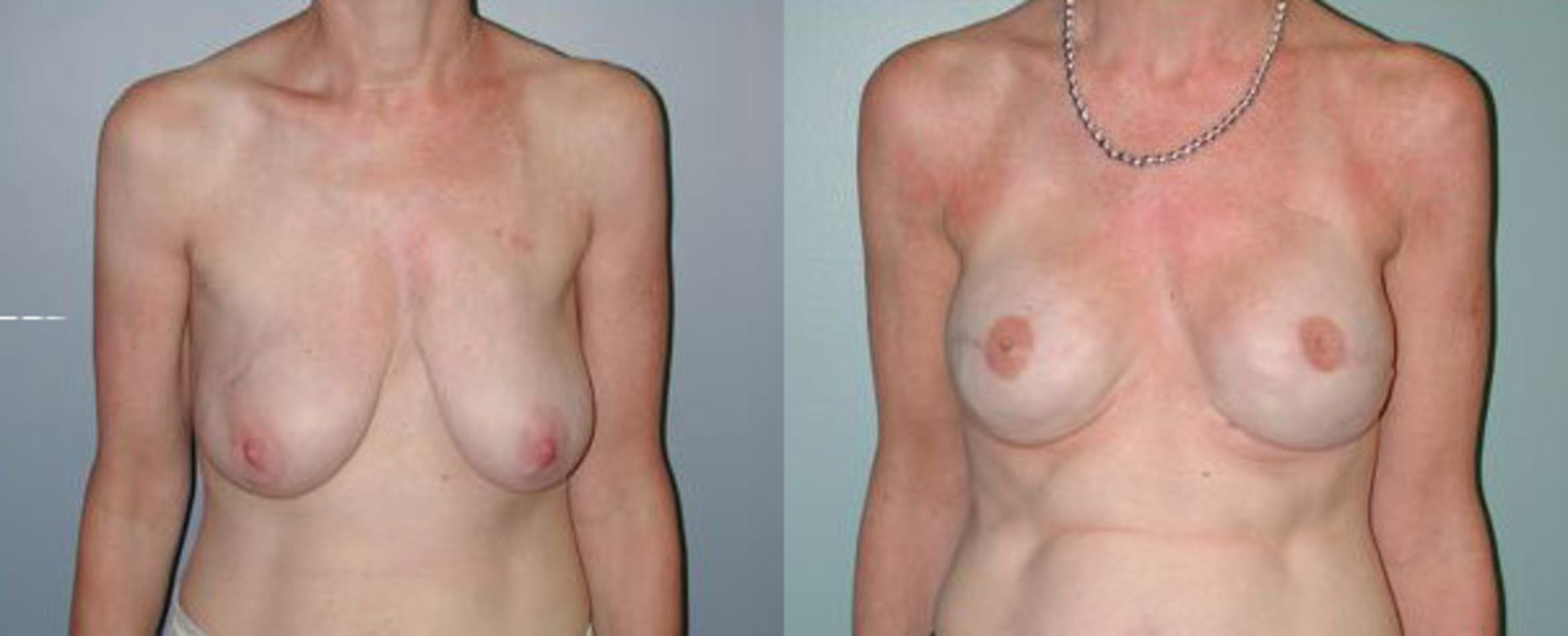 Before & After Breast Reconstruction Case 108 View #1 View in Albany & Latham, New York