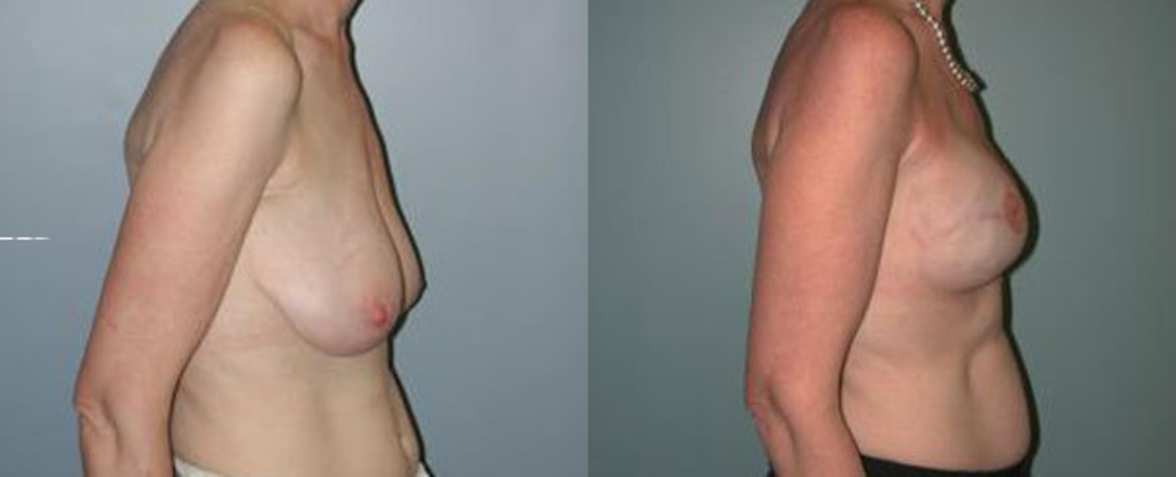 Before & After Breast Reconstruction Case 108 View #2 View in Albany & Latham, New York