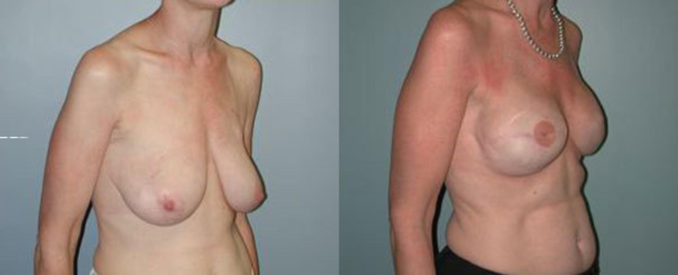 Before & After Breast Reconstruction Case 108 View #3 View in Albany & Latham, New York