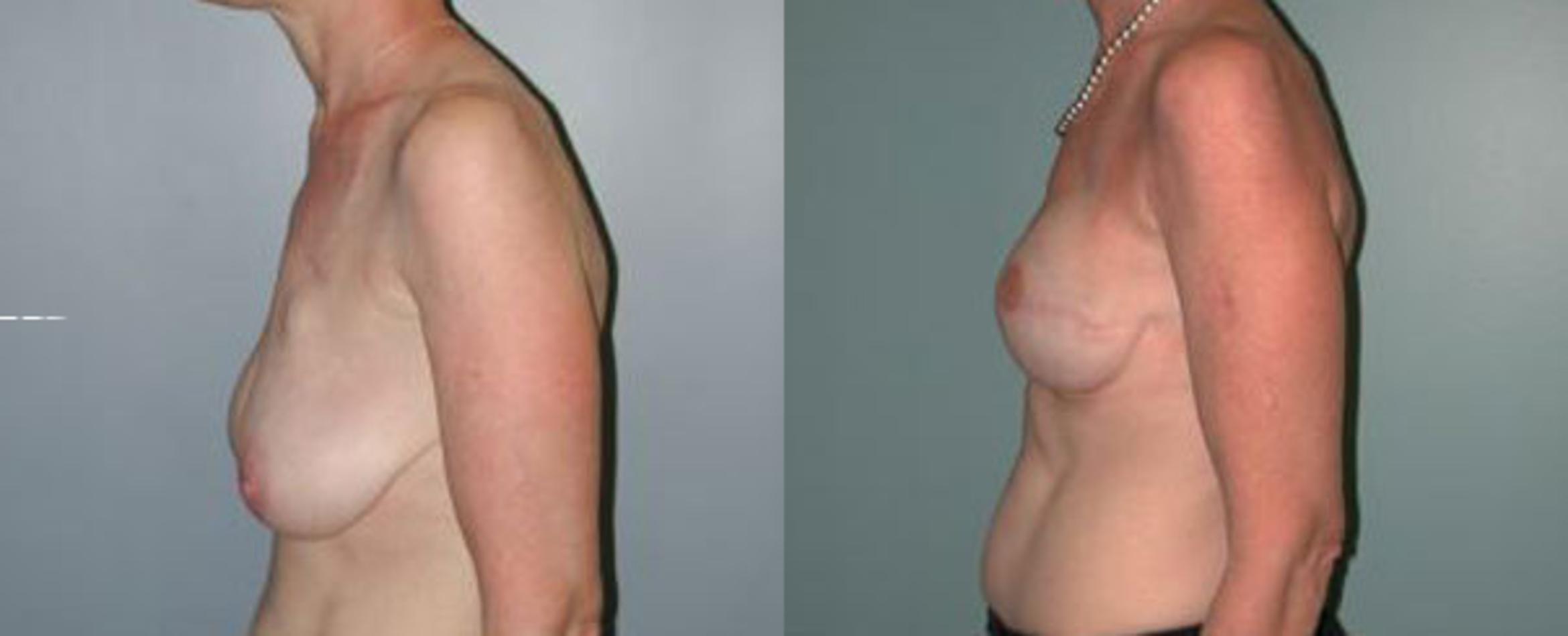 Before & After Breast Reconstruction Case 108 View #4 View in Albany & Latham, New York