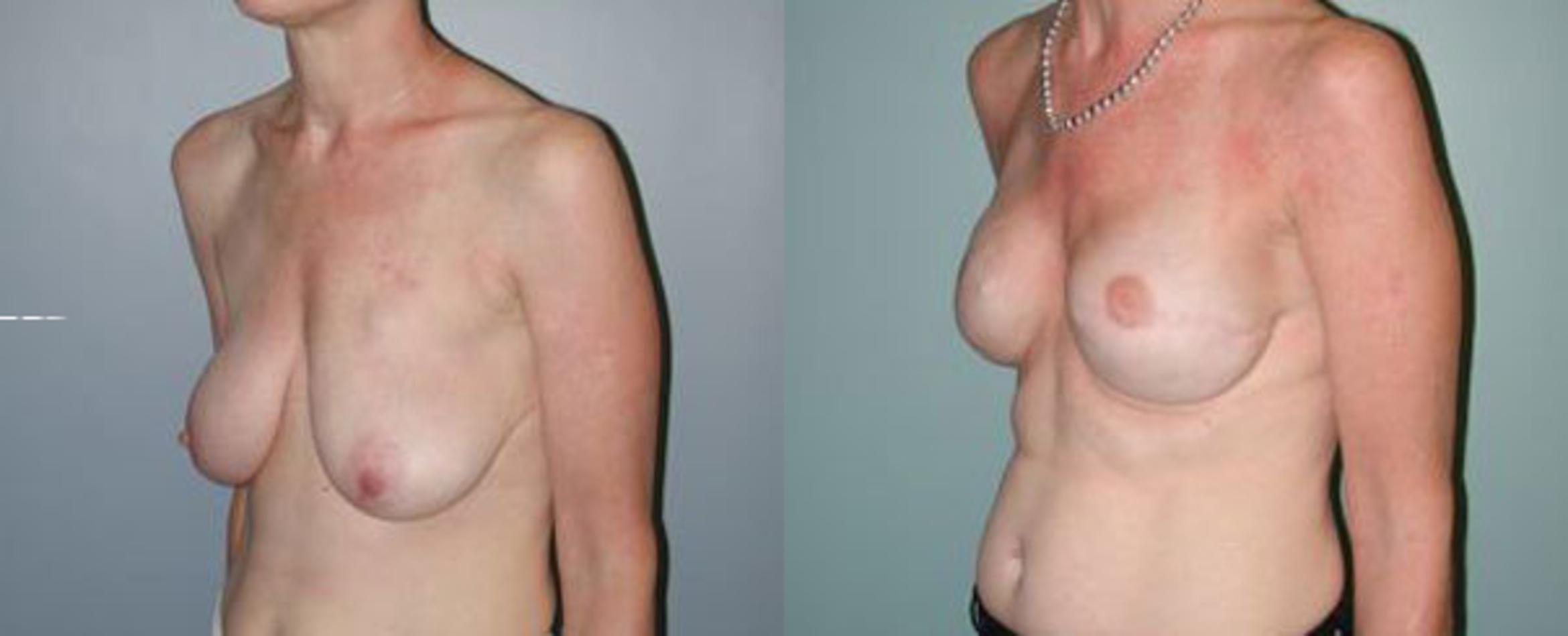 Before & After Breast Reconstruction Case 108 View #5 View in Albany & Latham, New York