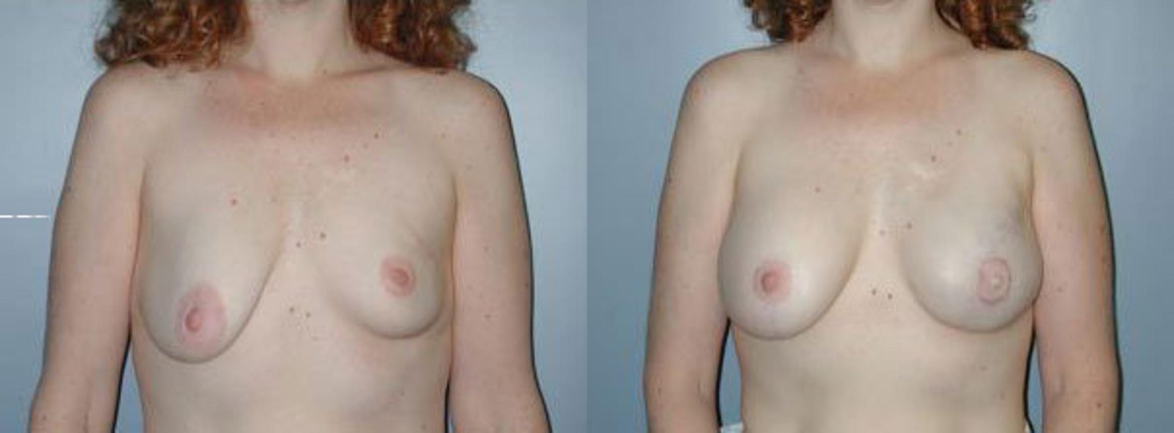 Before & After Breast Reconstruction Case 109 View #1 View in Albany & Latham, New York
