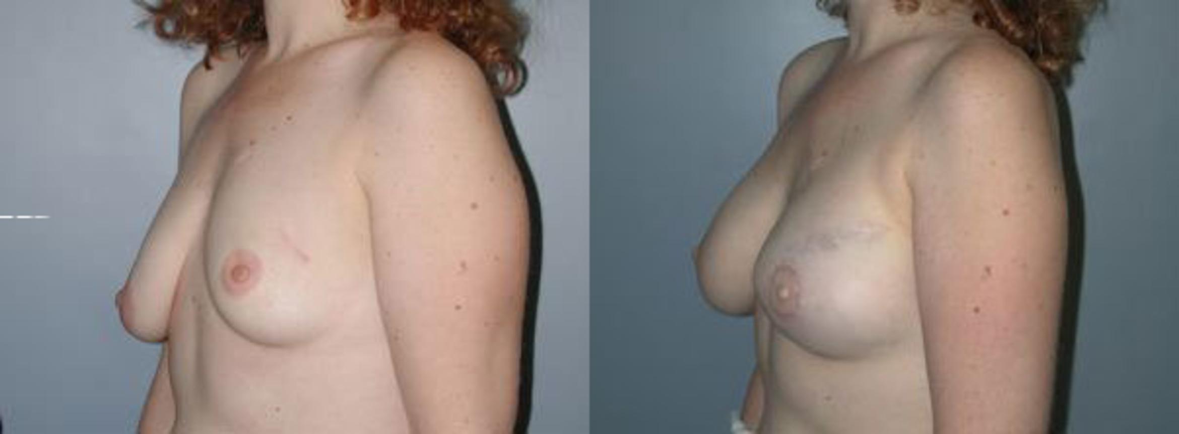 Before & After Breast Reconstruction Case 109 View #2 View in Albany & Latham, New York
