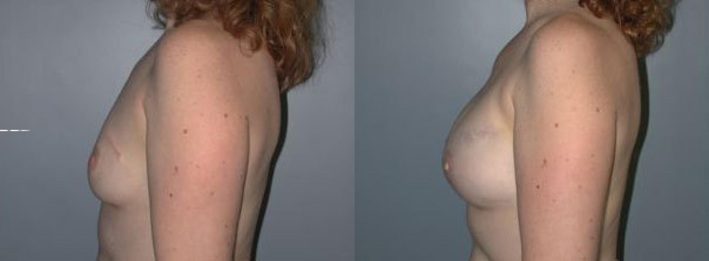Before & After Breast Reconstruction Case 109 View #3 View in Albany & Latham, New York