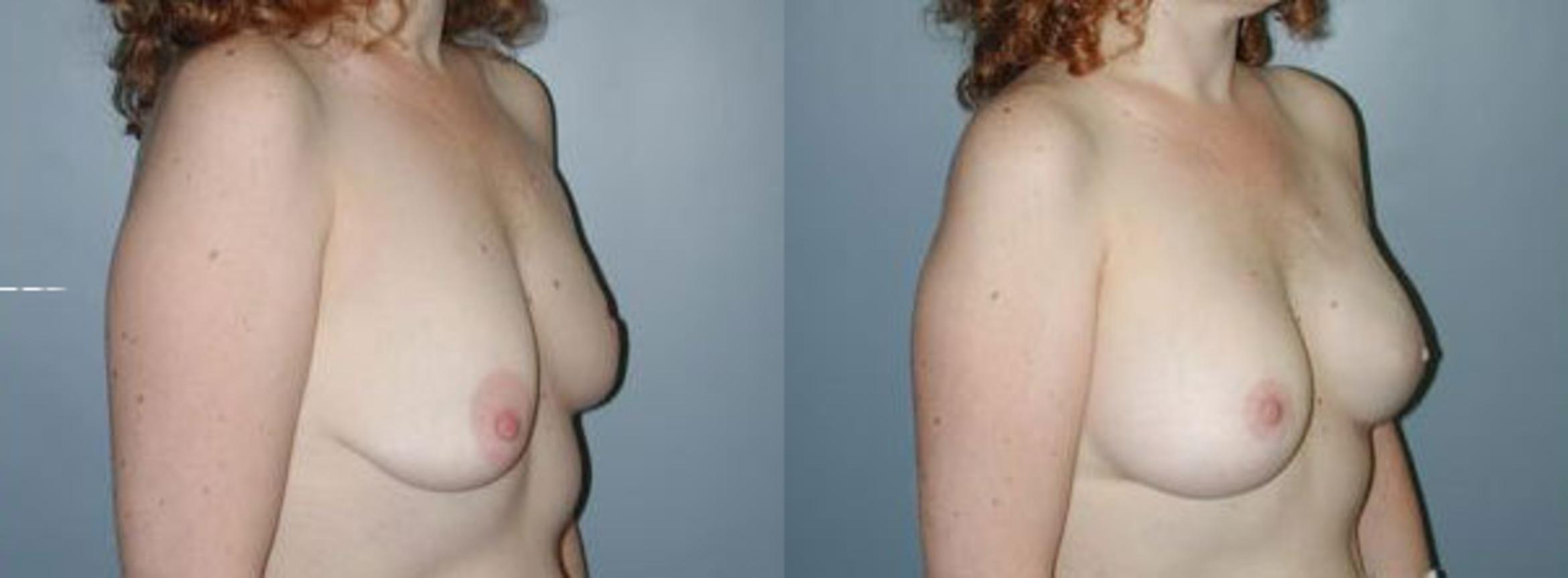 Before & After Breast Reconstruction Case 109 View #4 View in Albany & Latham, New York