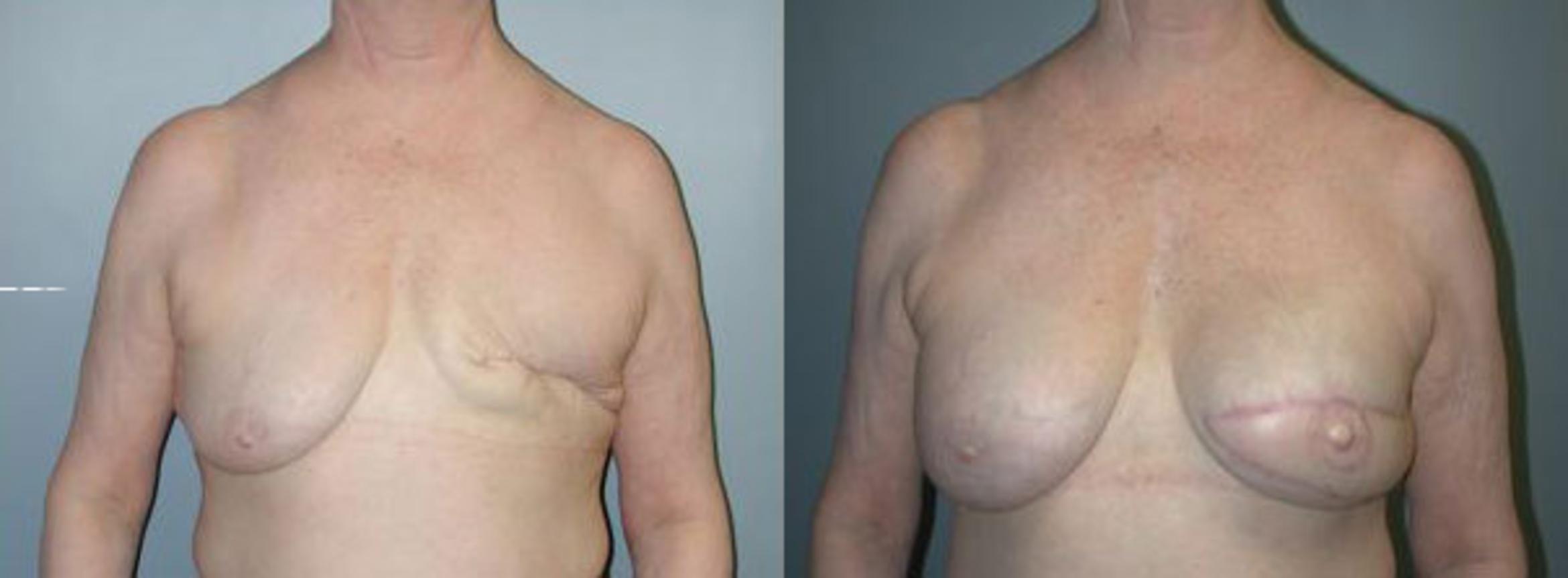 Before & After Breast Reconstruction Case 111 View #1 View in Albany & Latham, New York