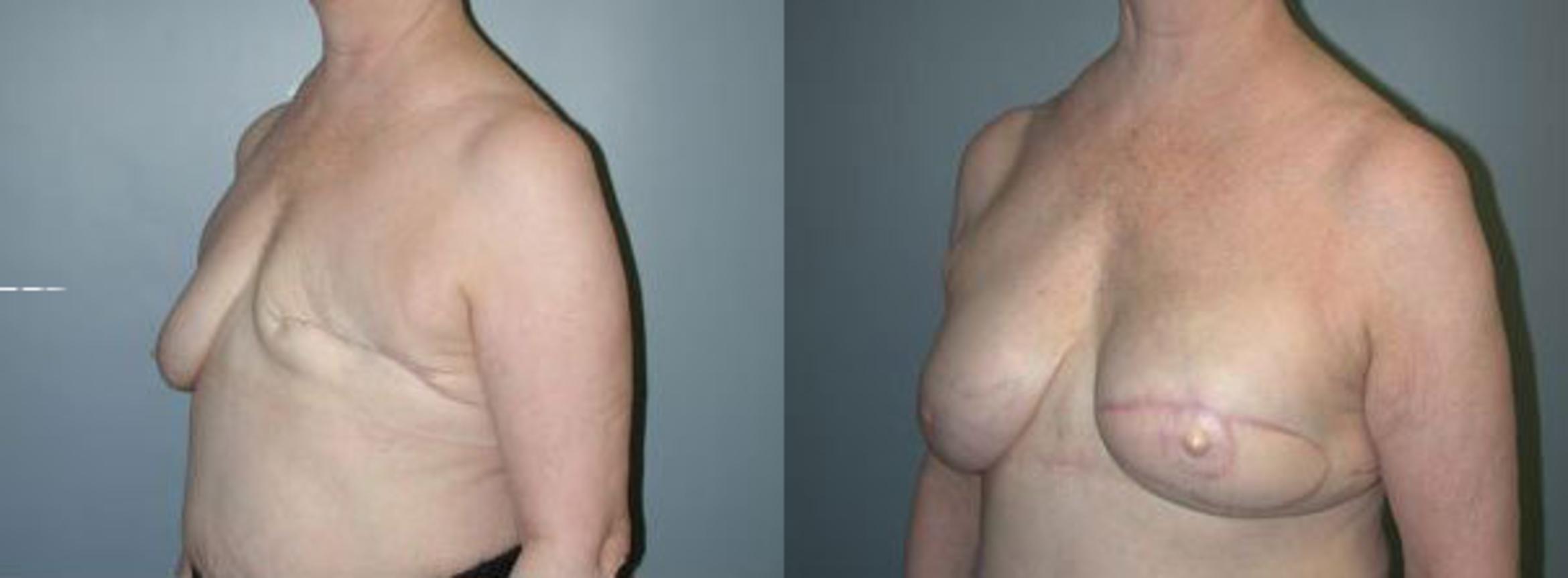 Before & After Breast Reconstruction Case 111 View #2 View in Albany & Latham, New York