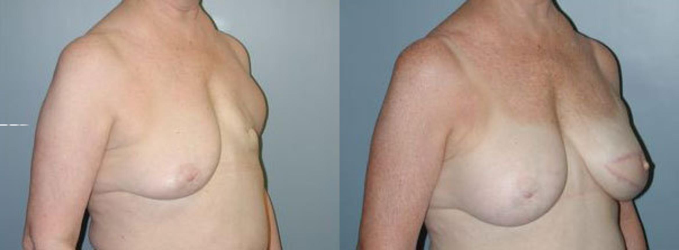 Before & After Breast Reconstruction Case 111 View #4 View in Albany & Latham, New York