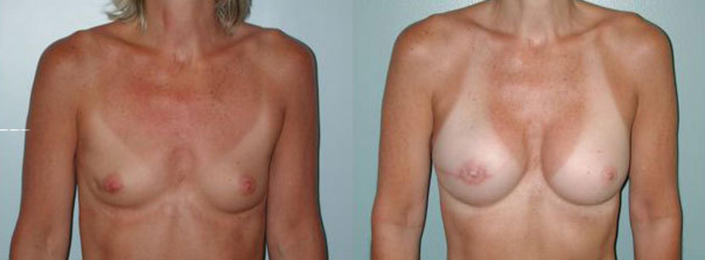 Before & After Breast Reconstruction Case 112 View #1 View in Albany & Latham, New York