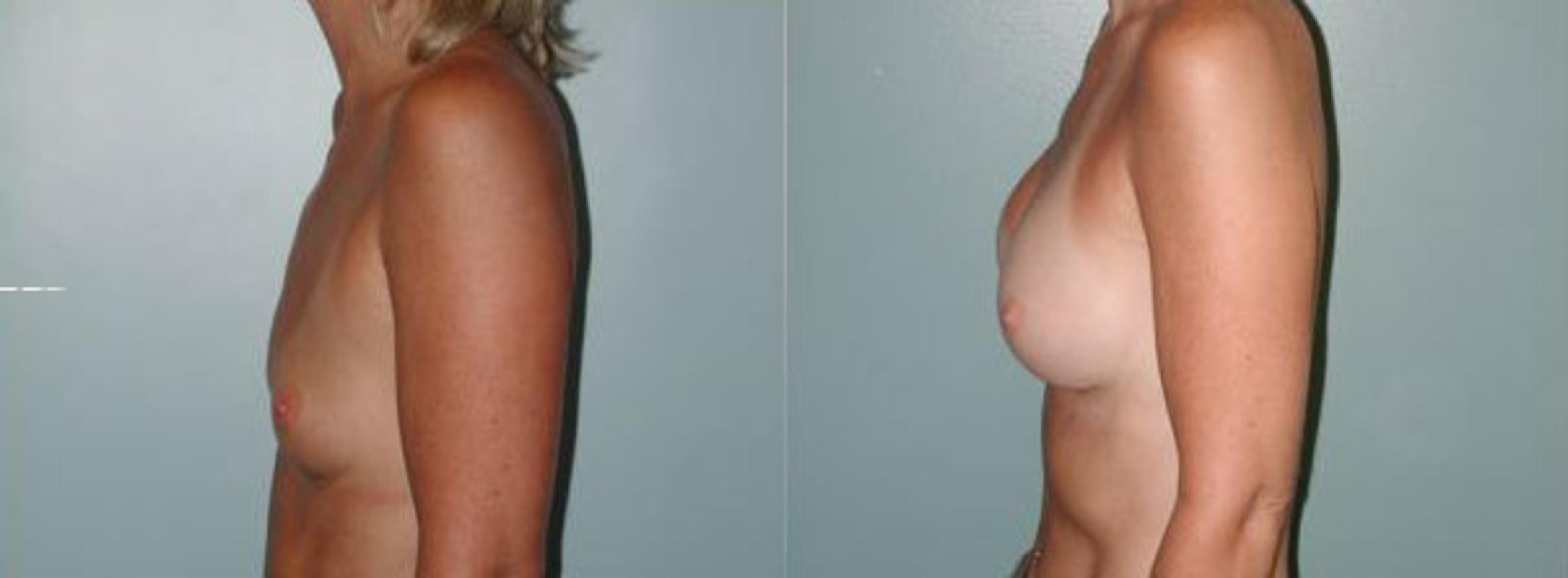 Before & After Breast Reconstruction Case 112 View #3 View in Albany & Latham, New York