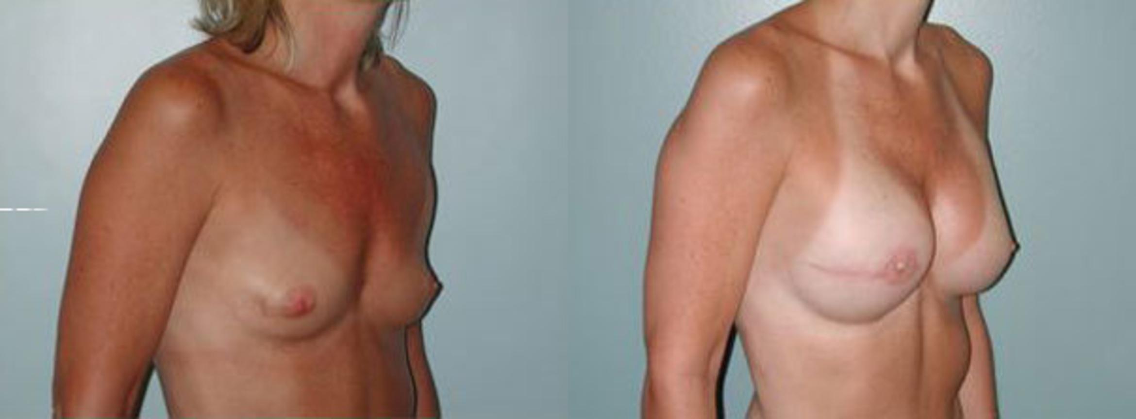 Before & After Breast Reconstruction Case 112 View #4 View in Albany & Latham, New York