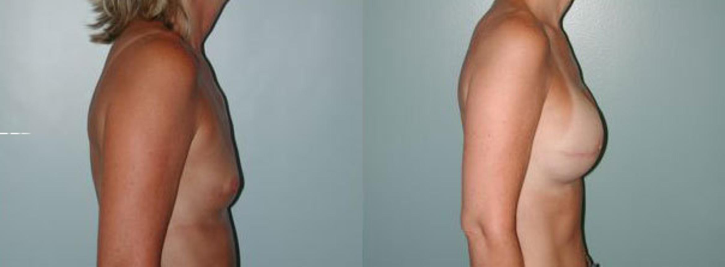 Before & After Breast Reconstruction Case 112 View #5 View in Albany & Latham, New York