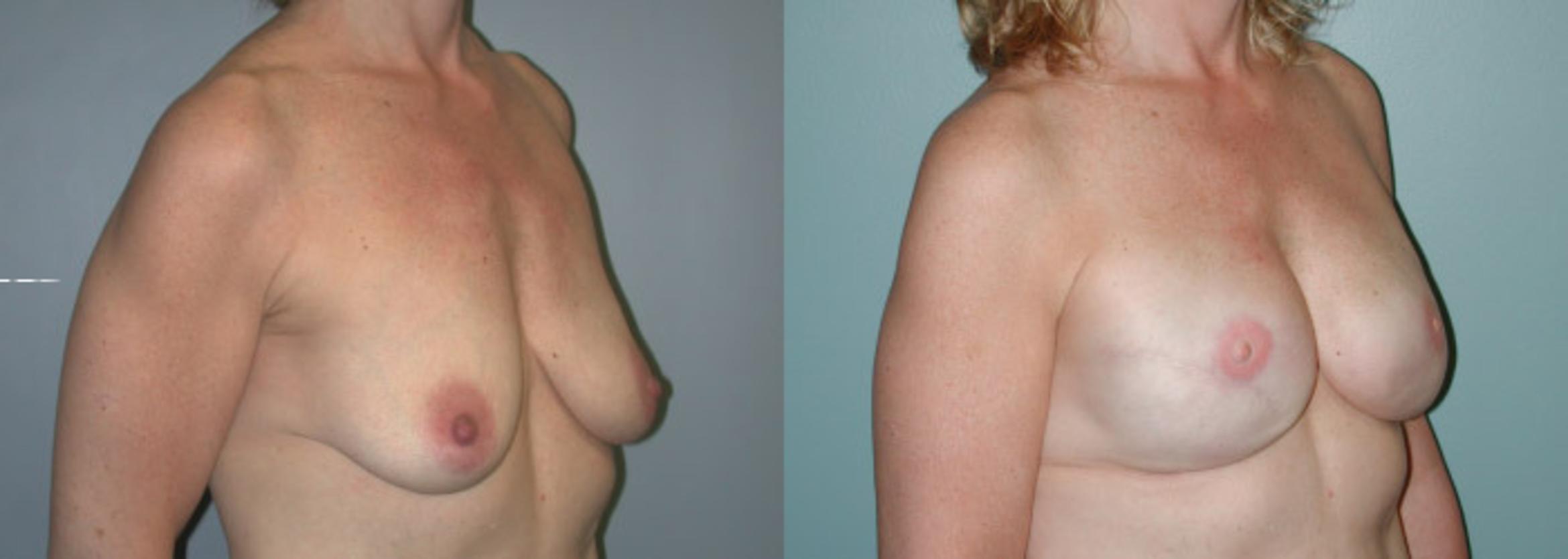 Before & After Breast Reconstruction Case 150 View #3 View in Albany & Latham, New York