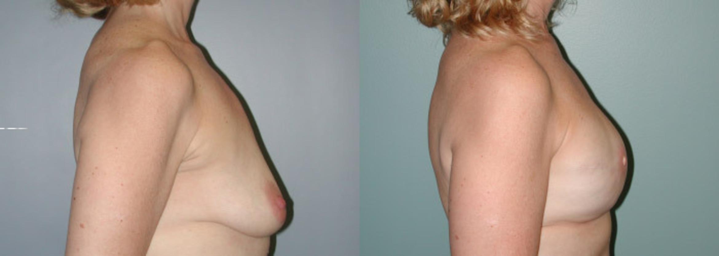 Before & After Breast Reconstruction Case 150 View #4 View in Albany & Latham, New York