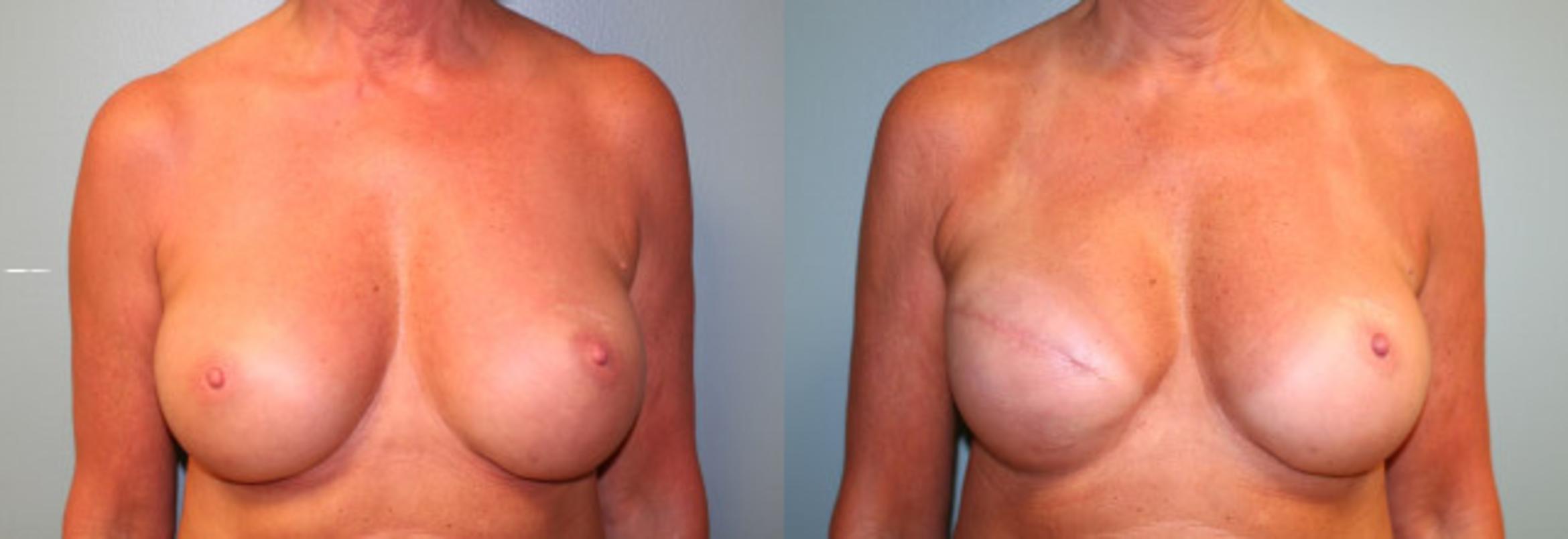 Before & After Breast Reconstruction Case 151 View #1 View in Albany & Latham, New York