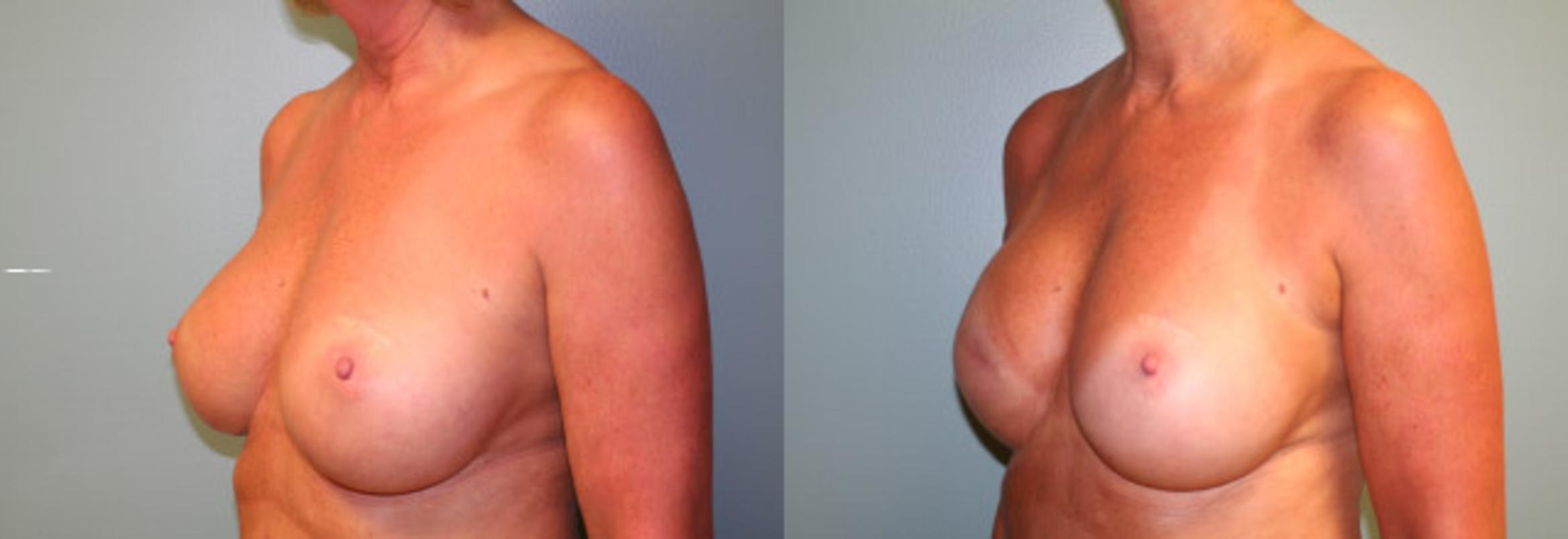 Before & After Breast Reconstruction Case 151 View #2 View in Albany & Latham, New York