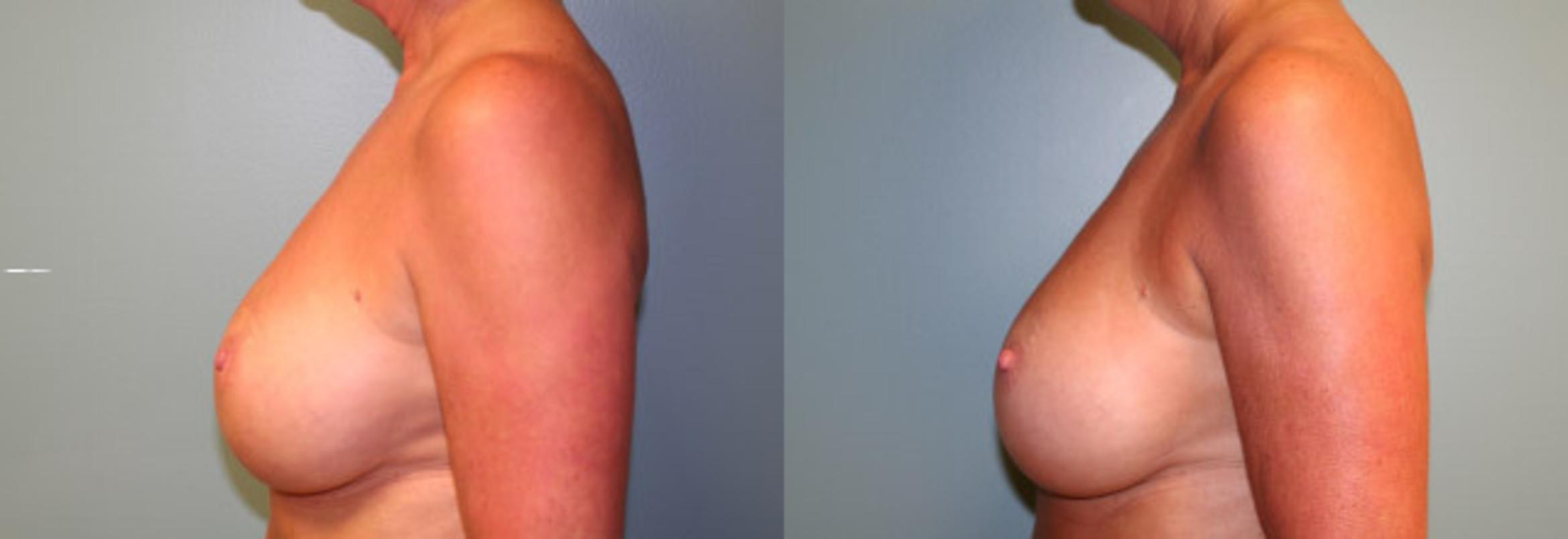 Before & After Breast Reconstruction Case 151 View #3 View in Albany & Latham, New York