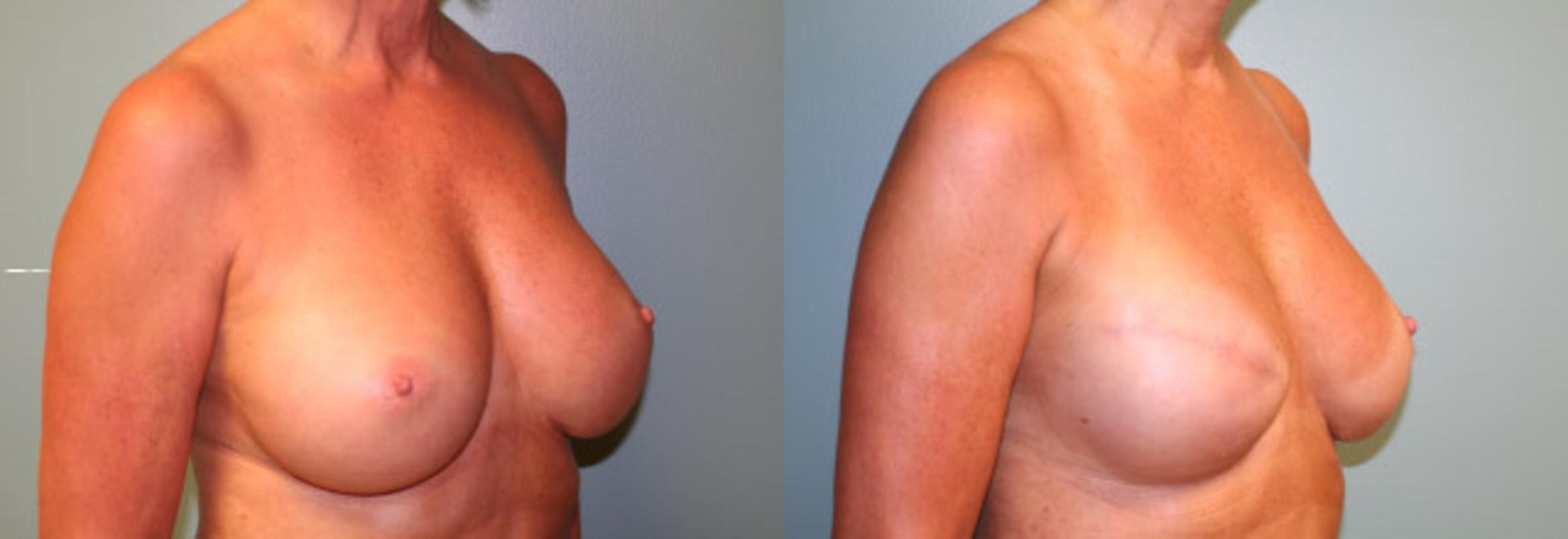 Before & After Breast Reconstruction Case 151 View #4 View in Albany & Latham, New York
