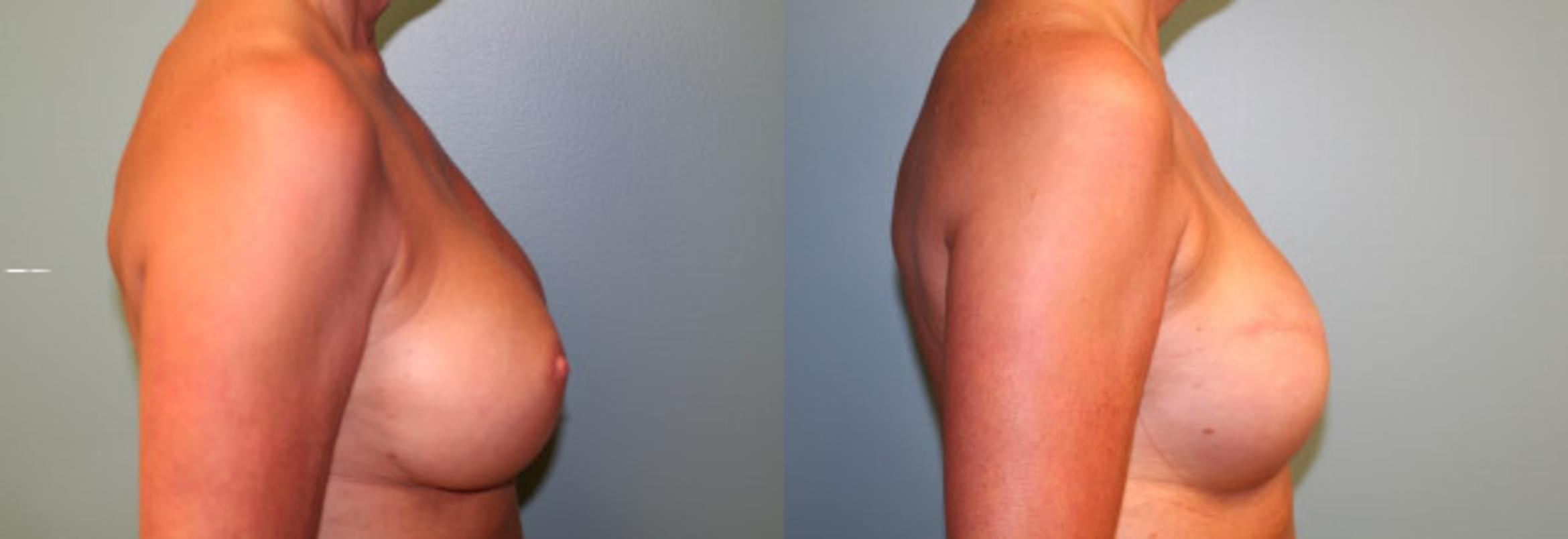 Before & After Breast Reconstruction Case 151 View #5 View in Albany & Latham, New York
