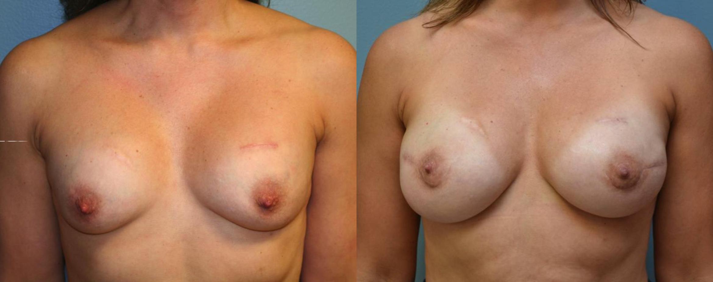 Before & After Breast Reconstruction Case 162 View #1 View in Albany & Latham, New York